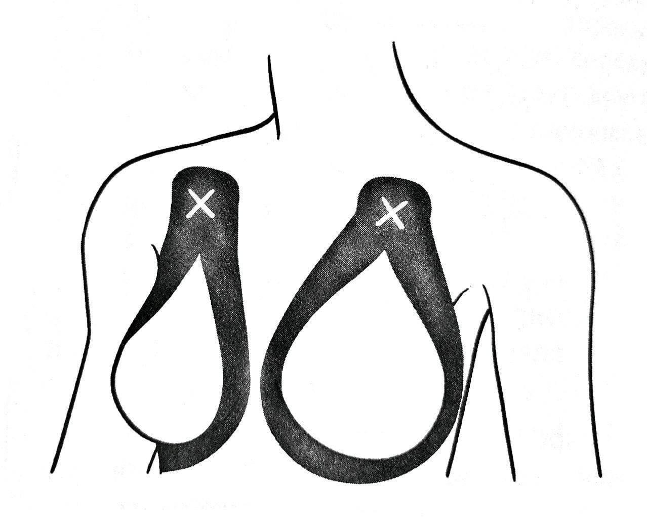 Схема тейпирования груди
